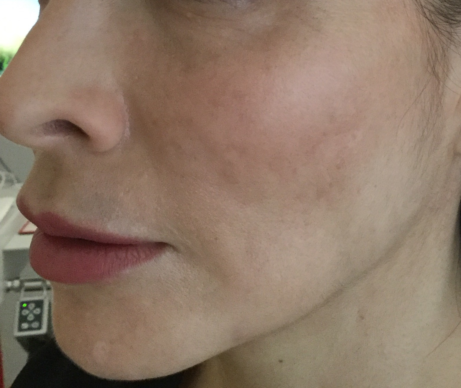 Melasma - Después del tratamiento